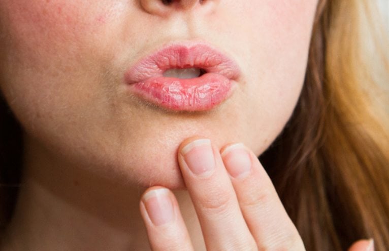 Don t Ignore These Dry Lips And Mouth Symptoms 