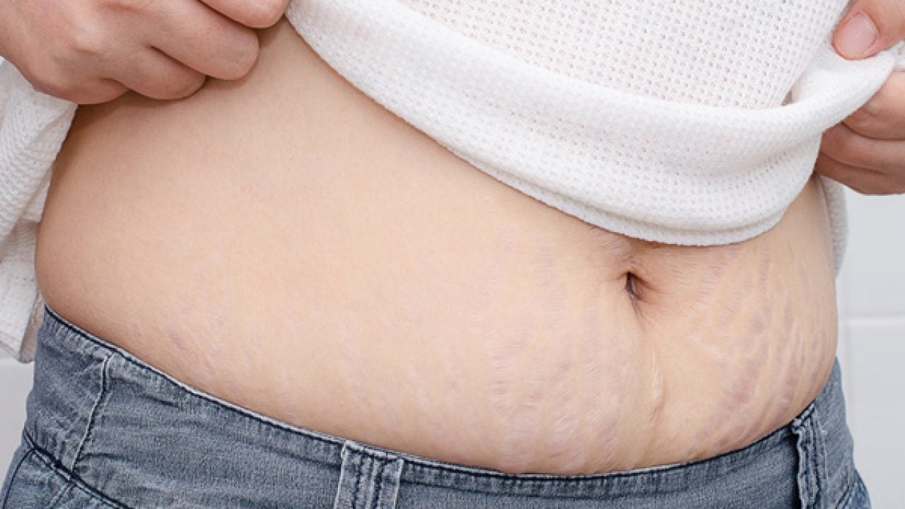 How is the diagnosis of stretch Marks made?