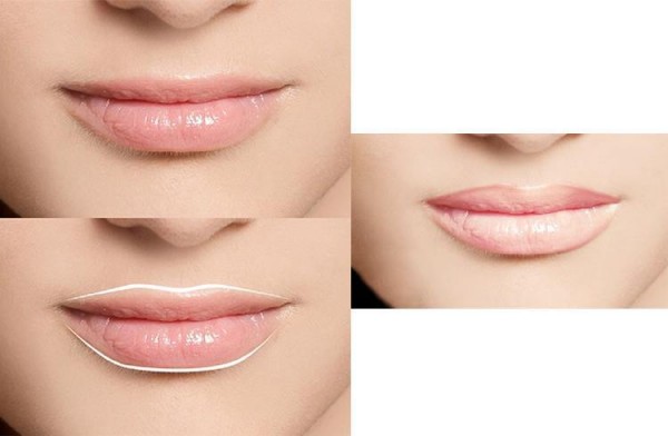 Know All About Lip Reduction Without Surgery