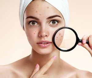 How To Cover Pimples Without Makeup   How To Cover Pimples Without Foundation 300x257 