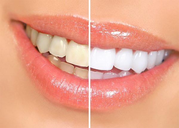 top-8-causes-of-white-gums-around-teeth