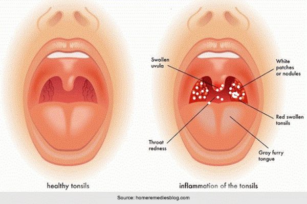 Top 4 Causes And Treatments For White Spots On The Throat   White Spots On The Throat 600x400 