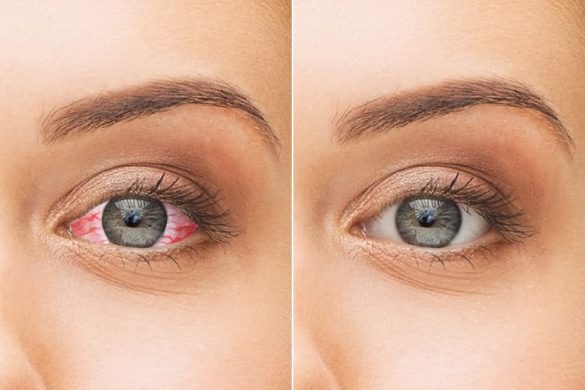 10 Home Remedies For Dry Eyes You Need To Try Today